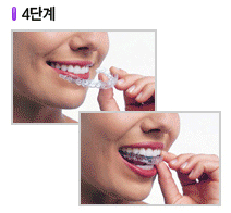 인비절라인 4단계